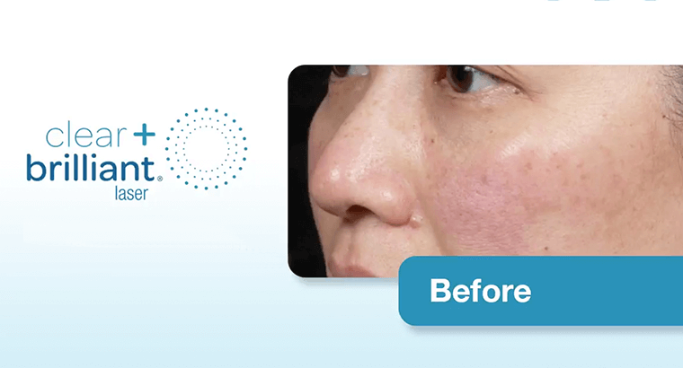 oog-thermage-after