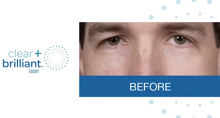 oog-thermage-after1