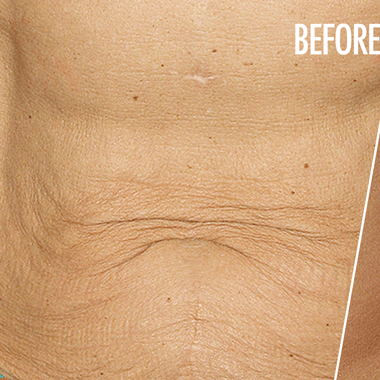 slappe-huid slappe-huid