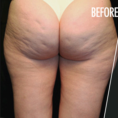 thermage-cellulite